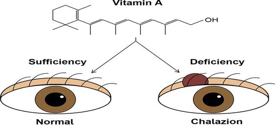 Chalazion: Symptoms, Causes, Treatments